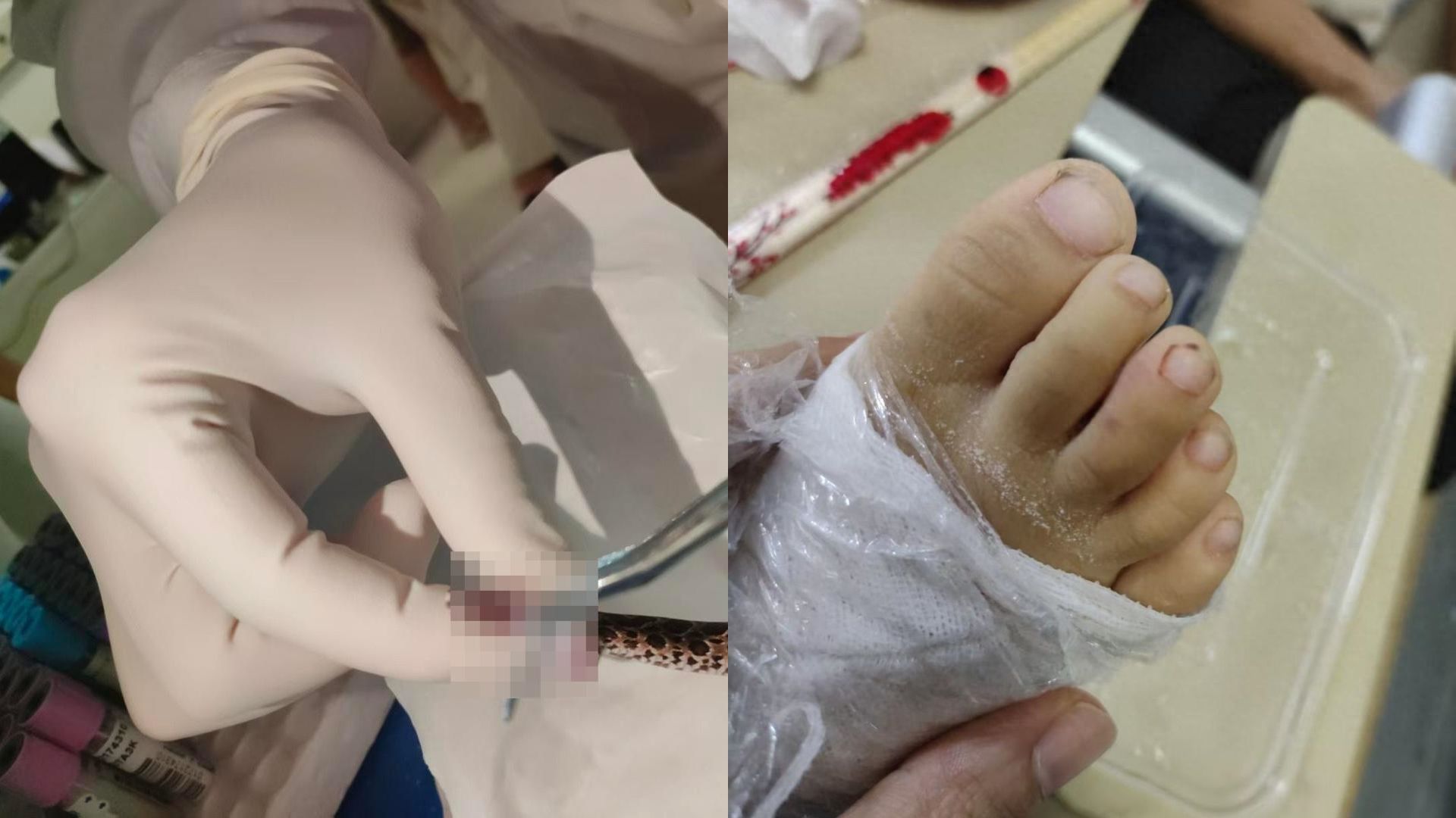 家长开门不到1分钟，4岁女童被毒蛇咬伤，医生：这是泰国圆斑蝰
