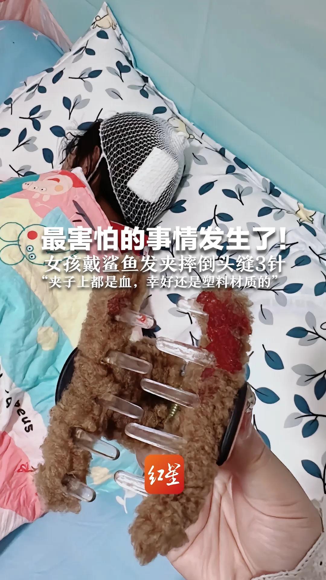 最害怕的事情发生了！女孩戴鲨鱼发夹摔倒头缝3针“夹子上都是血，幸好还是塑料材质的”