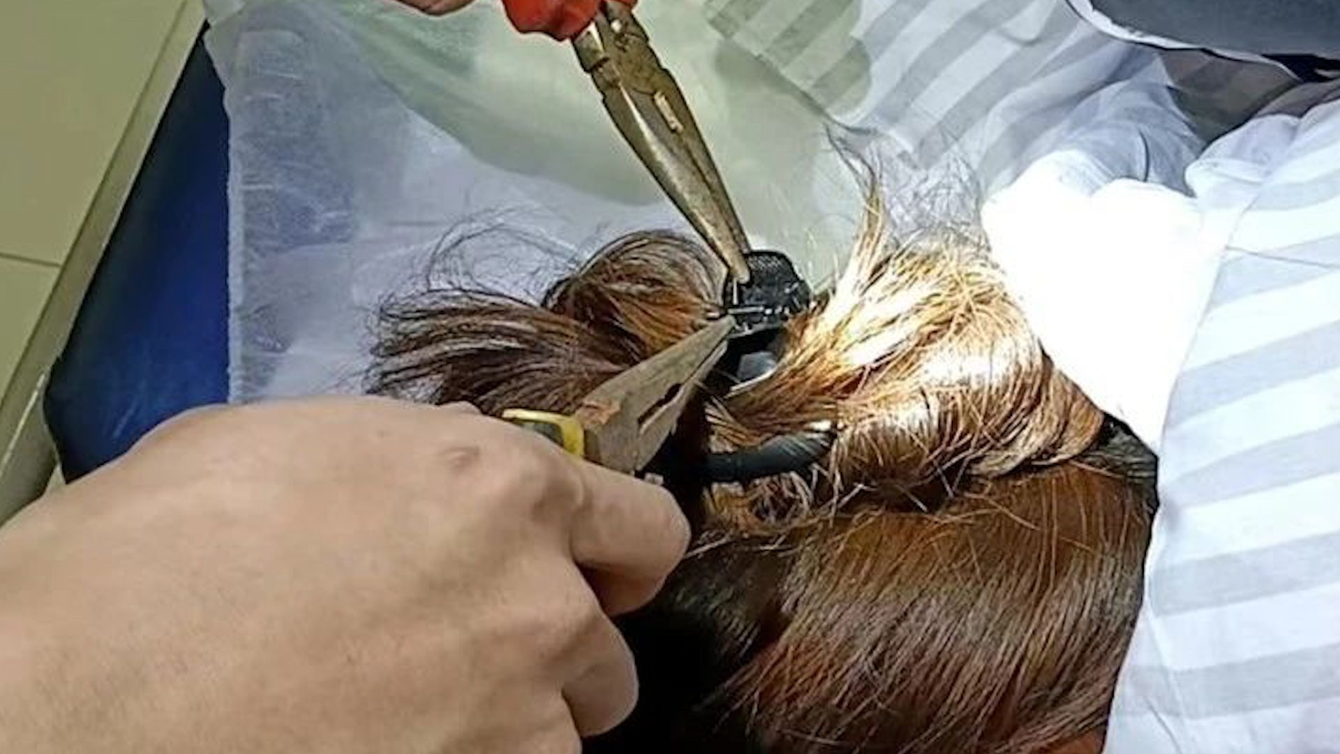 女子出车祸鲨鱼夹直插后脑，头皮被扎破，医护凌晨求助消防拆解